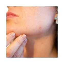 حب الشباب والبشرة