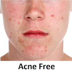 تطبيق Acne skin care